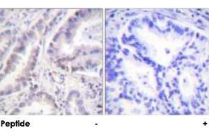 Immunohistochemical analysis of paraffin-embedded human lung carcinoma tissue using CDC6 polyclonal antibody .