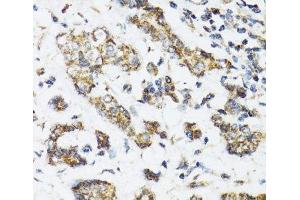 Immunohistochemistry of paraffin-embedded Human breast cancer using DHRS2 Polyclonal Antibody at dilution of 1:100 (40x lens).