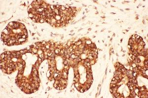 Anti-Src Picoband antibody,  IHC(P): Human Mammary Cancer Tissue (Src antibody  (AA 2-368))