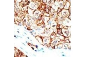 Formalin-fixed and paraffin-embedded human cancer tissue reacted with the primary antibody, which was peroxidase-conjugated to the secondary antibody, followed by AEC staining. (Ubiquilin 1 antibody  (AA 296-326))