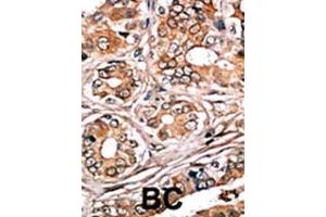 Formalin-fixed and paraffin-embedded human cancer tissue reacted with the primary antibody, which was peroxidase-conjugated to the secondary antibody, followed by AEC staining. (Retinoblastoma 1 antibody  (pSer780))