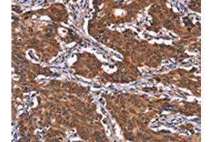 The image on the left is immunohistochemistry of paraffin-embedded Human gastric cancer tissue using ABIN7191188(KCNJ9 Antibody) at dilution 1/15, on the right is treated with synthetic peptide. (KCNJ9 antibody)