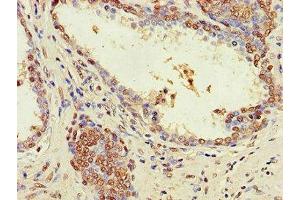 Immunohistochemistry of paraffin-embedded human prostate cancer using ABIN7176555 at dilution of 1:100