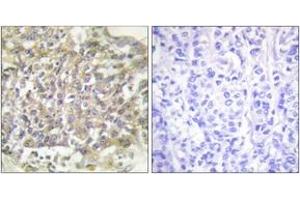 Immunohistochemistry analysis of paraffin-embedded human breast carcinoma tissue, using Shc (Ab-349) Antibody.