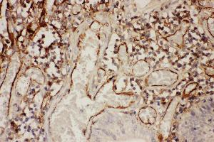 Anti-ICAM1 Picoband antibody, IHC(P) IHC(P): Human Intestinal Cancer Tissue