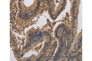 Immunohistochemistry of Human liver cancer using KCNA7 Polyclonal Antibody at dilution of 1:40