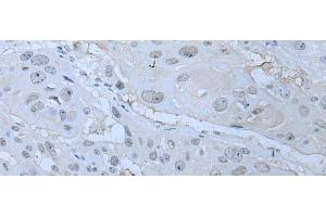 Immunohistochemistry of paraffin-embedded Human esophagus cancer tissue using HUWE1 Polyclonal Antibody at dilution of 1:30(x200) (HUWE1 antibody)