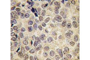 IHC analysis of FFPE human prostate carcinoma tissue stained with Dnmt3b antibody (DNMT3B antibody  (AA 389-417))