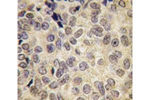 IHC analysis of FFPE human prostate carcinoma tissue stained with Dnmt3b antibody (DNMT3B antibody  (AA 389-417))