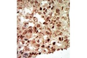 Formalin-fixed and paraffin-embedded human cancer tissue (breast carcinoma) reacted with the primary antibody, which was peroxidase-conjugated to the secondary antibody, followed by AEC staining. (MAPK11 antibody  (Middle Region))
