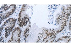 Immunohistochemistry of paraffin-embedded Human colon cancer tissue using RBMS1 Polyclonal Antibody at dilution 1:30 (RBMS1 antibody)