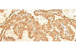 Immunohistochemistry of paraffin-embedded Human thyroid cancer tissue using TIPRL Polyclonal Antibody at dilution of 1:60(x200) (TIPRL antibody)