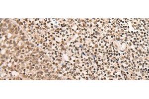 Immunohistochemistry of paraffin-embedded Human tonsil tissue using ARID1B Polyclonal Antibody at dilution of 1:40(x200) (ARID1B antibody)