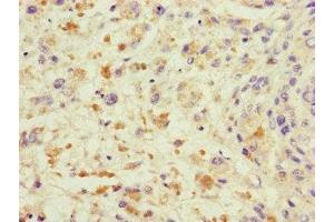 Immunohistochemistry of paraffin-embedded human melanoma using ABIN7172232 at dilution of 1:100 (TRAF2 antibody  (AA 147-281))