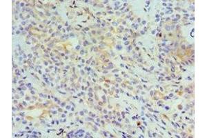 Immunohistochemistry of paraffin-embedded human breast cancer using ABIN7173799 at dilution of 1:100 (TNFSF13 antibody  (AA 105-247))