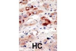 Formalin-fixed and paraffin-embedded human cancer tissue reacted with the primary antibody, which was peroxidase-conjugated to the secondary antibody, followed by DAB staining. (PIK3C3 antibody  (N-Term))