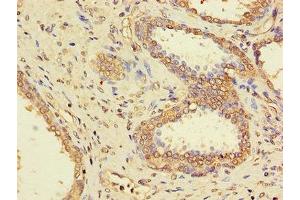 Immunohistochemistry of paraffin-embedded human prostate cancer using ABIN7169312 at dilution of 1:100 (PPP1CC antibody  (Catalytic Subunit))