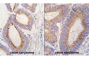 Formalin-fixed and paraffin-embedded human colon carcinoma tissue reacted with GDF11 polyclonal antibody  , which was peroxidase-conjugated to the secondary antibody, followed by DAB staining.