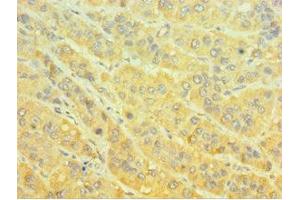 Immunohistochemistry of paraffin-embedded human liver cancer using ABIN7160651 at dilution of 1:100 (MTMR4 antibody  (AA 570-820))