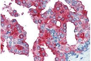 Human Prostate (formalin-fixed, paraffin-embedded) stained with FOLH1 antibody ABIN364431 at 10 ug/ml followed by biotinylated anti-mouse IgG secondary antibody ABIN481714, alkaline phosphatase-streptavidin and chromogen. (PSMA antibody)