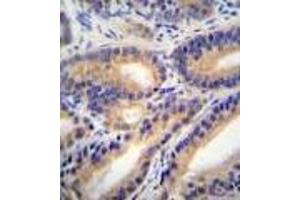 HSD11B1L Antibody : immunohistochemistry analysis in formalin fixed and paraffin embedded human prostate carcinoma followed by peroxidase conjugation of the secondary antibody and DAB staining.