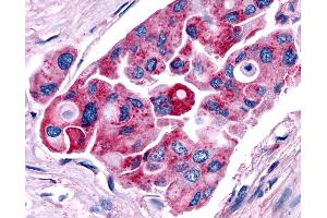 Anti-TRH Receptor / TRHR antibody IHC of human Lung, Non-Small Cell Carcinoma. (TRHR antibody  (C-Term))