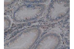 IHC-P analysis of Human Rectum Cancer Tissue, with DAB staining. (Angiotensin I Converting Enzyme 1 antibody  (AA 1160-1306))