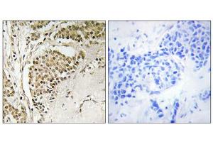 Immunohistochemistry analysis of paraffin-embedded human breast carcinoma tissue using NOM1 antibody. (NOM1 antibody  (C-Term))