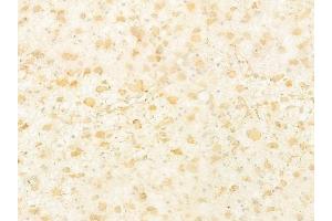 ABIN6264550 and ABIN6277788 at 1/100 staining human astrocytoma by IHC-P. (RAB10 antibody  (C-Term))