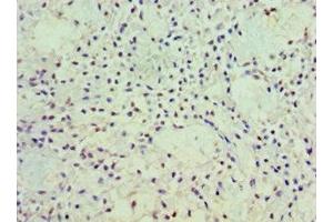 Immunohistochemistry of paraffin-embedded human breast cancer using ABIN7162919 at dilution of 1:100 (Periostin antibody  (AA 557-836))
