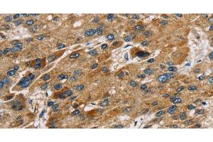 Immunohistochemistry of paraffin-embedded Human liver cancer using SULT1B1 Polyclonal Antibody at dilution of 1:30 (SULT1B1 antibody)
