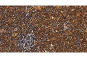 Immunohistochemistry of paraffin-embedded Human Lymphoma using CDC34 Polyclonal Antibody at dilution of 1:50 (CDC34 antibody)
