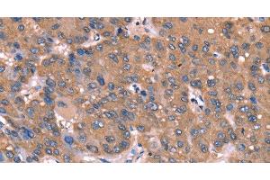 Immunohistochemistry of paraffin-embedded Human liver cancer tissue using GCSAM Polyclonal Antibody at dilution 1:40 (GCET2 antibody)
