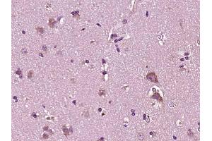 Paraformaldehyde-fixed, paraffin embedded human brain glioma; Antigen retrieval by boiling in sodium citrate buffer (pH6) for 15min; Block endogenous peroxidase by 3% hydrogen peroxide for 30 minutes; Blocking buffer (normal goat serum) at 37°C for 20min; Antibody incubation with YKL39/CHI3L2 Polyclonal Antibody, Unconjugated (bs-1238R) at 1:200 overnight at 4°C, followed by a conjugated secondary and DAB staining. (CHI3L2 antibody  (AA 121-220))
