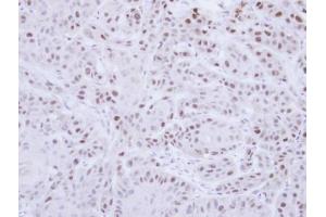 IHC-P Image Immunohistochemical analysis of paraffin-embedded Cal27 Xenograft, using RAD18, antibody at 1:100 dilution. (RAD18 antibody  (Center))