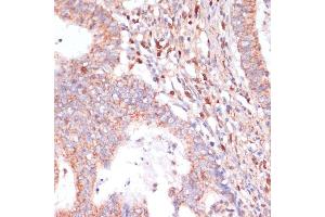 Immunohistochemistry of paraffin-embedded human colon carcinoma using C antibody (ABIN7266010) at dilution of 1:100 (40x lens). (CACNB2 antibody  (AA 481-660))