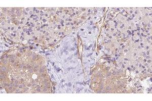 ABIN6273337 at 1/100 staining Human thyroid cancer tissue by IHC-P. (UBE2E2 antibody  (N-Term))