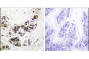 Immunohistochemistry analysis of paraffin-embedded human lung carcinoma tissue, using p53 (Ab-382) Antibody. (p53 antibody  (AA 344-393))