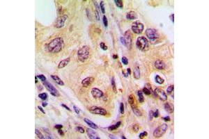 Immunohistochemical analysis of B-RAF staining in human liver cancer formalin fixed paraffin embedded tissue section. (SNRPE antibody  (Center))