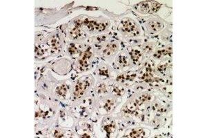 Immunohistochemical analysis of CREB (pS129) staining in human breast cancer formalin fixed paraffin embedded tissue section. (CREB1 antibody  (pSer129))