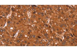Immunohistochemistry of paraffin-embedded Human liver cancer tissue using Cyclin D3 Polyclonal Antibody at dilution 1:40 (Cyclin D3 antibody)