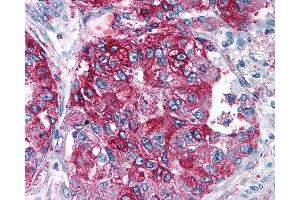 Anti-NPY5R antibody IHC of human Lung, Adenocarcinoma. (NPY5R antibody  (Cytoplasmic Domain))
