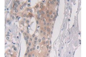 Detection of PSMb6 in Human Breast cancer Tissue using Polyclonal Antibody to Proteasome Subunit Beta Type 6 (PSMb6) (PSMB6 antibody  (AA 2-239))