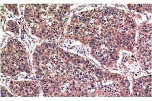 Immunohistochemistry of paraffin-embedded Human lung carcinoma tissue using Phospho-AKT1 (Ser473) Monoclonal Antibody at dilution of 1:200 (AKT1 antibody  (pSer473))