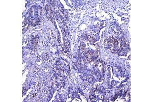 IHC testing of FFPE human rectal cancer tissue with CD41 antibody at 1ug/ml.