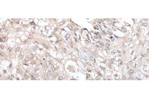 Immunohistochemistry of paraffin-embedded Human lung cancer tissue using VRK3 Polyclonal Antibody at dilution of 1:45(x200) (VRK3 antibody)