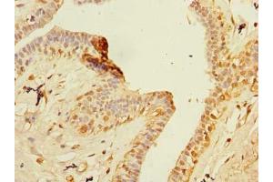 Immunohistochemistry of paraffin-embedded human breast cancer using ABIN7176473 at dilution of 1:100 (ZNF726P1 antibody  (AA 1-389))