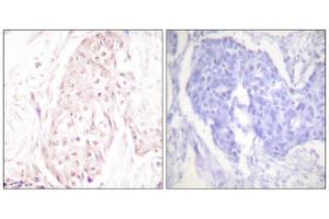 Immunohistochemistry analysis of paraffin-embedded human breast carcinoma tissue using SENP8 antibody. (SENP8 antibody  (C-Term))
