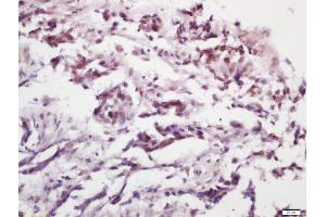Formalin-fixed and paraffin embedded human gastric cancer labeled with Anti-Phospho-MDM2(Ser186) Polyclonal Antibody, Unconjugated (ABIN802548) at 1:200 followed by conjugation to the secondary antibody and DAB staining