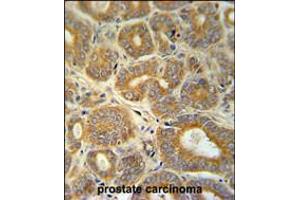 CRABP1 Antibody immunohistochemistry analysis in formalin fixed and paraffin embedded human prostate carcinoma followed by peroxidase conjugation of the secondary antibody and DAB staining. (CRABP1 antibody  (C-Term))